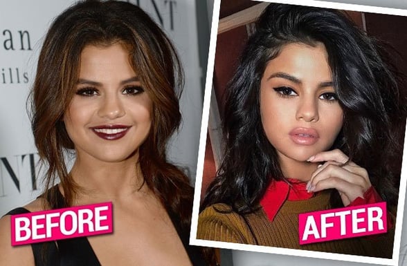 Selena-Gomez-Lip-Injections-Plastic-Surgery